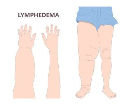 Medical illustration comparing a swollen arm and leg affected by lymphedema with unaffected limbs
